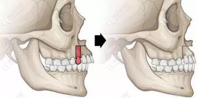 韩国正颌和国内正颌手术的区别除了术前不用正畸外,还有啥