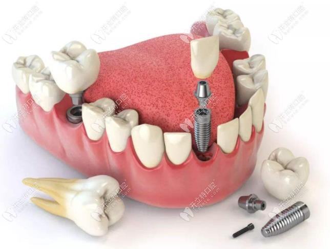 拿捏种植体周围炎的临床表现和处理方法可预防种植牙脱落
