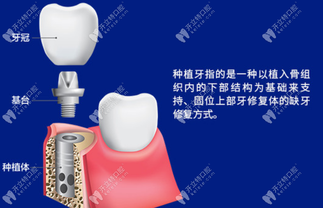南京雅康口腔的种植牙技术