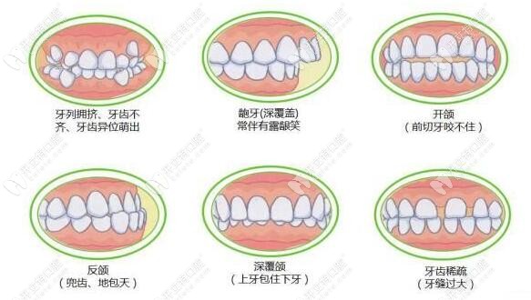牙齒矯正適應(yīng)癥