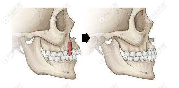 小正颌手术示意图