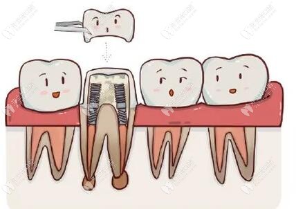 根管治疗后牙齿劈裂怎么办