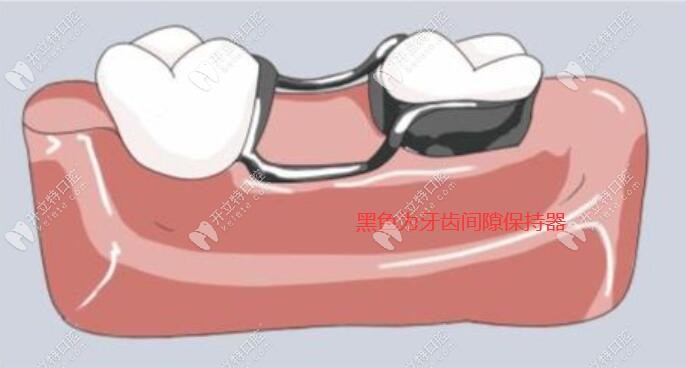 牙齿间隙保持器图片