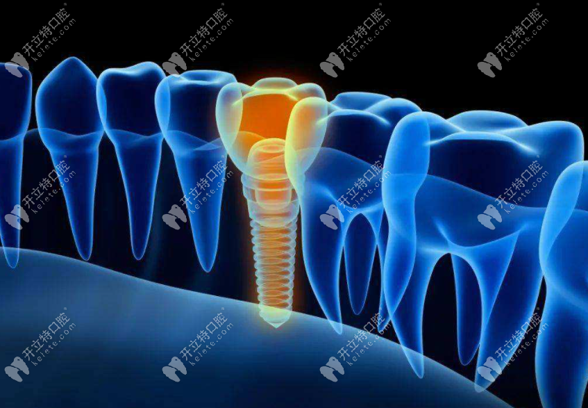 判断骨质条件和缺牙位置