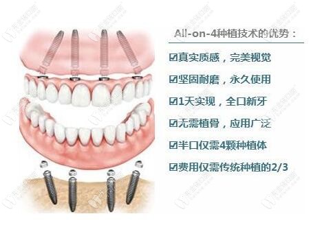 60岁以上老人做种植牙怎么样？60岁种牙好还是活动假牙更好