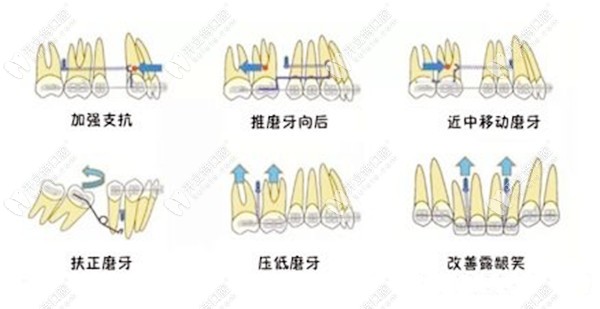 支抗钉的作用和适应症