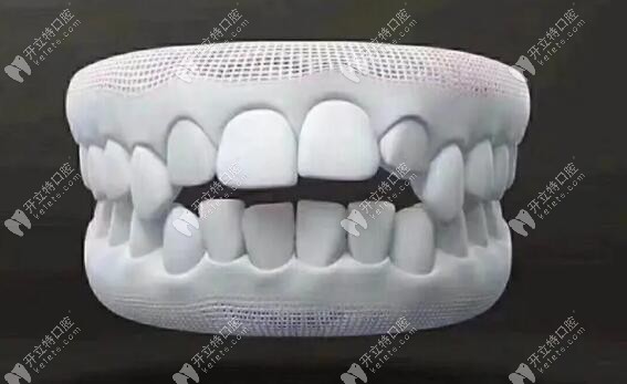 开颌的牙齿情况