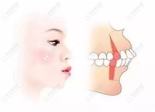 骨性龅牙是做正颌单颌还是双颌好