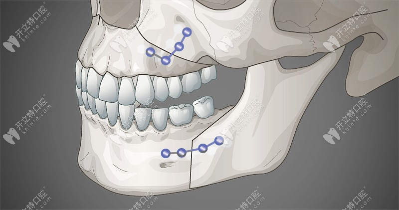 双颌手术是怎么操作的