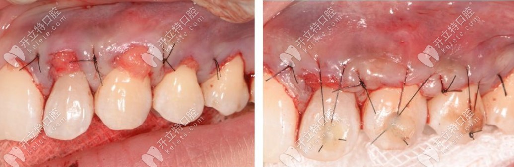 牙龈萎缩膜龈手术治疗图
