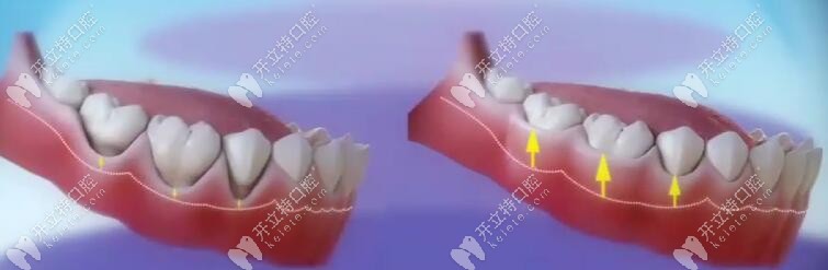 牙龈萎缩做膜龈手术前后对比