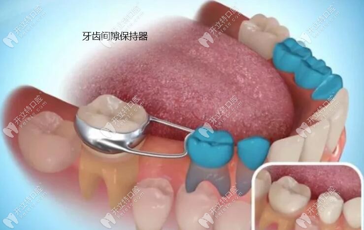 牙齿间隙保持器