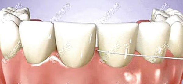 牙线扁线