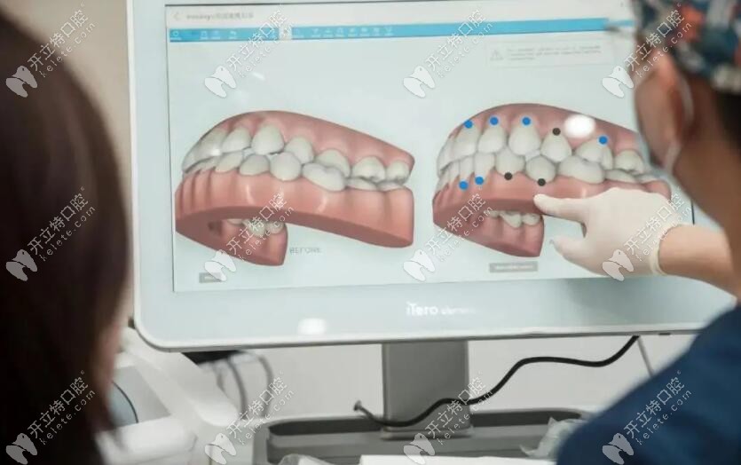 隐适美矫正口扫仪