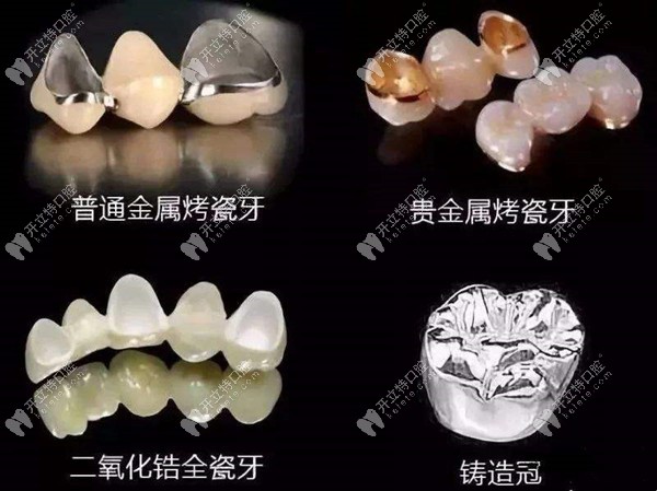聚石口腔牙齿修复的费用
