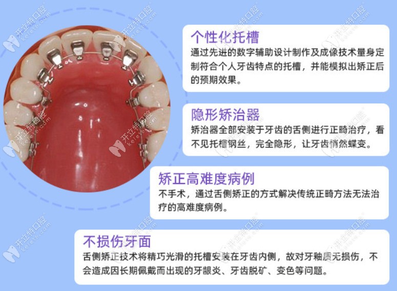 贵阳柏德齿科舌侧隐形矫正技术的优点