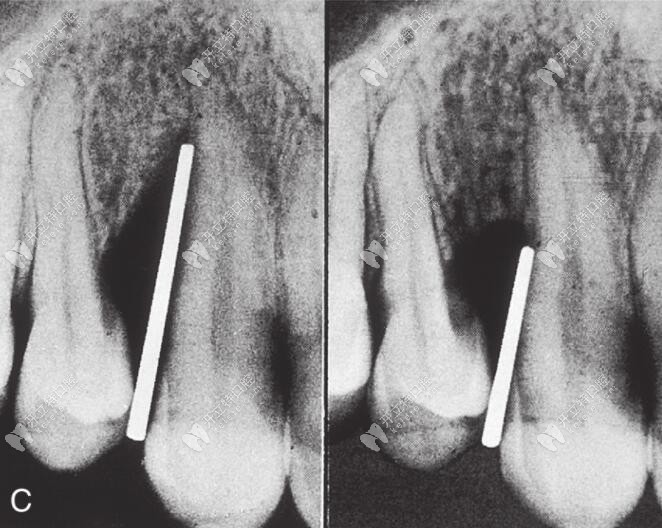 牙周再生术前后对比