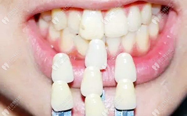 门牙做全瓷牙可以用多少年,做国产的跟进口哪个能用更久