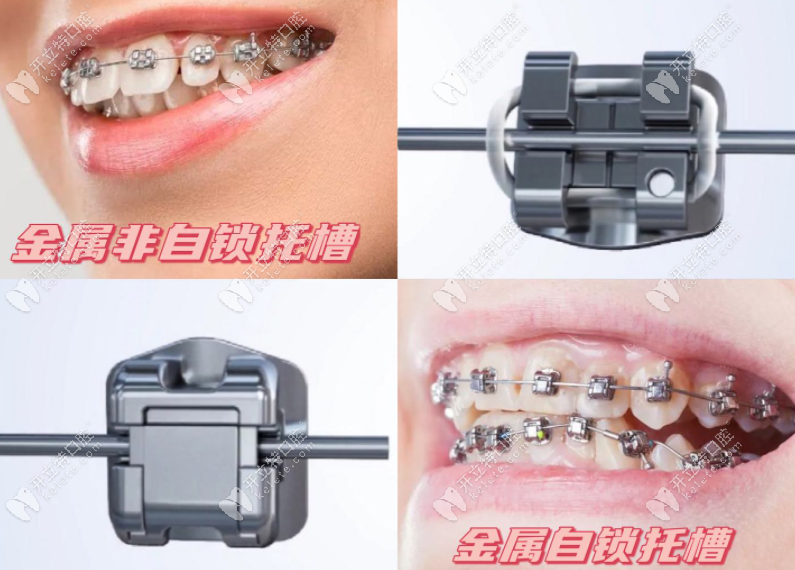 传统牙套和自锁牙套的区别图