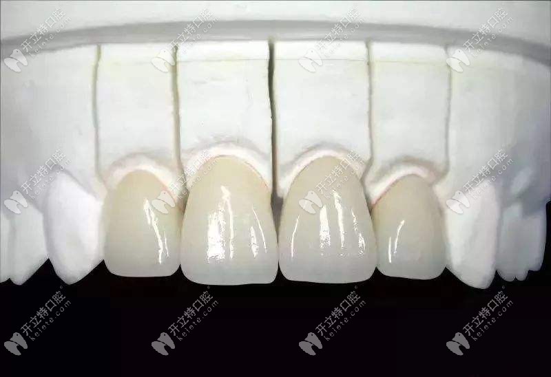 二氧化锆全瓷牙的优点有哪些