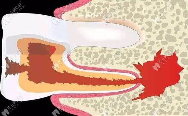 牙骨质增生的形成原因是什么