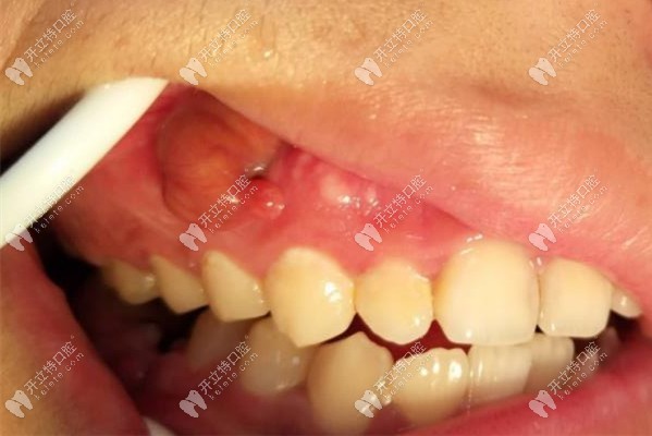牙槽骨增生图图片