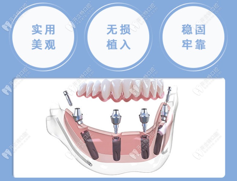 贵阳柏的口腔半口种植牙的优势