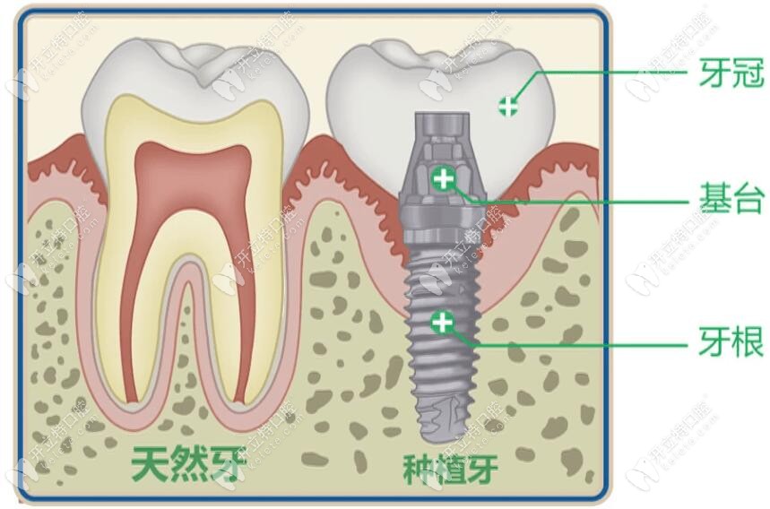 人工种植牙结构解析
