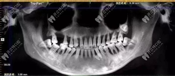 28岁姑娘因牙周炎导致半口牙被拔掉，看来牙龈出血不容小觑