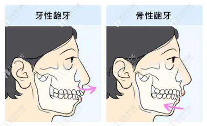 牙性凸嘴和骨性凸嘴的区别