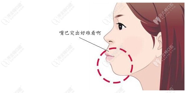 长期抿嘴会改善凸嘴吗?那得先搞清真凸嘴和假凸嘴的区别