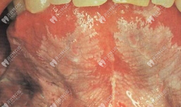 口腔粘膜毛状白斑早期图