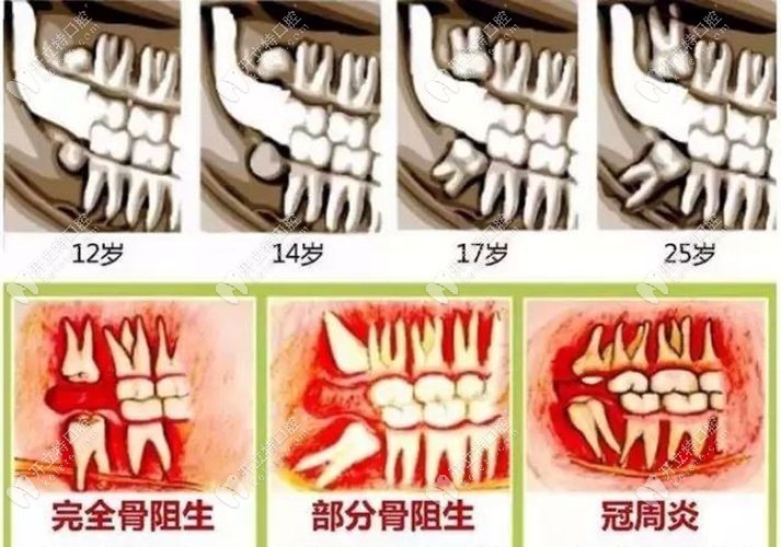 哪些智齿牙是需要拔除的呢