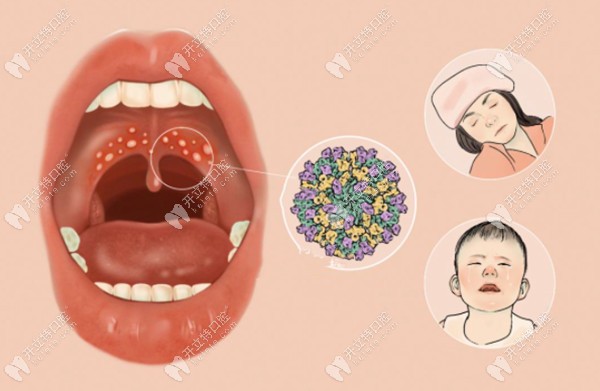 口腔疱疹症状表现