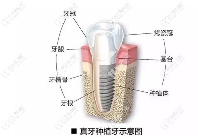 种植牙示意图