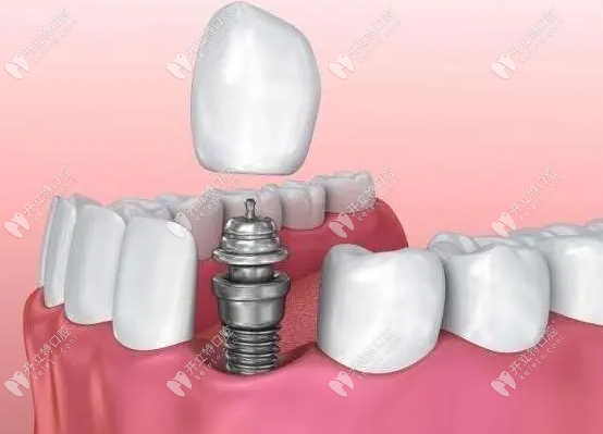 种植牙对缺牙患者的身体条件有一定的要求