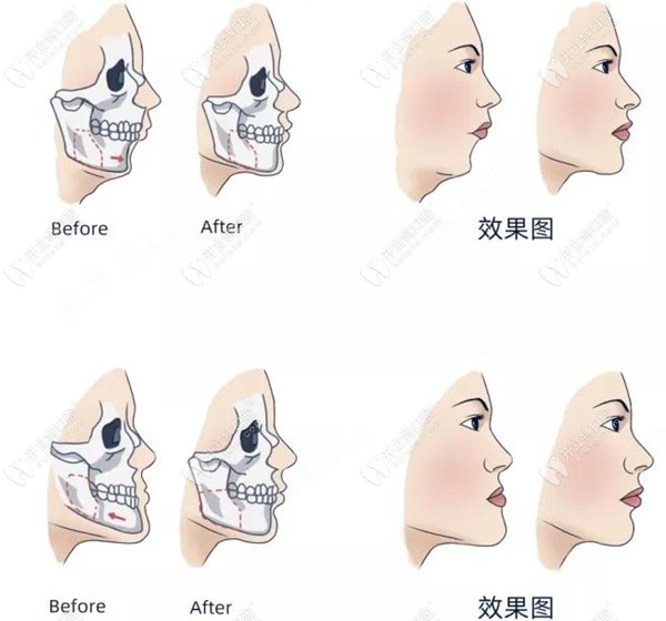 正颌手术后脸型改变图