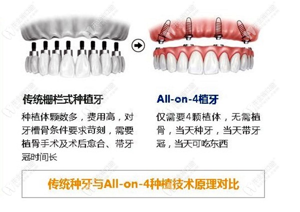 传统种植牙跟all on 4的区别