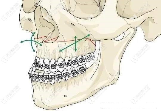 正颌手术——上颌骨截骨术