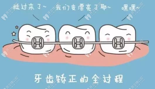 上颌窦提升是可以做牙齿矫正的