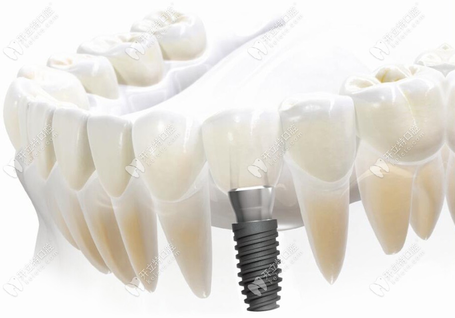 Dentis种植牙品牌介绍