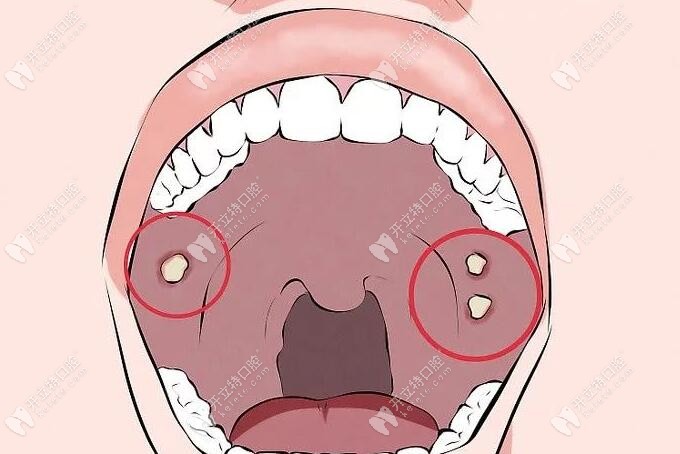 牙龈癌早期主要表现为溃疡