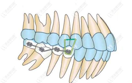 片段弓局部矫正
