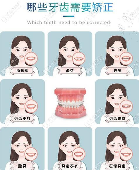 牙齿畸形类型