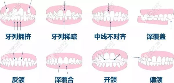 牙齿矫正的时间与多种因素有关
