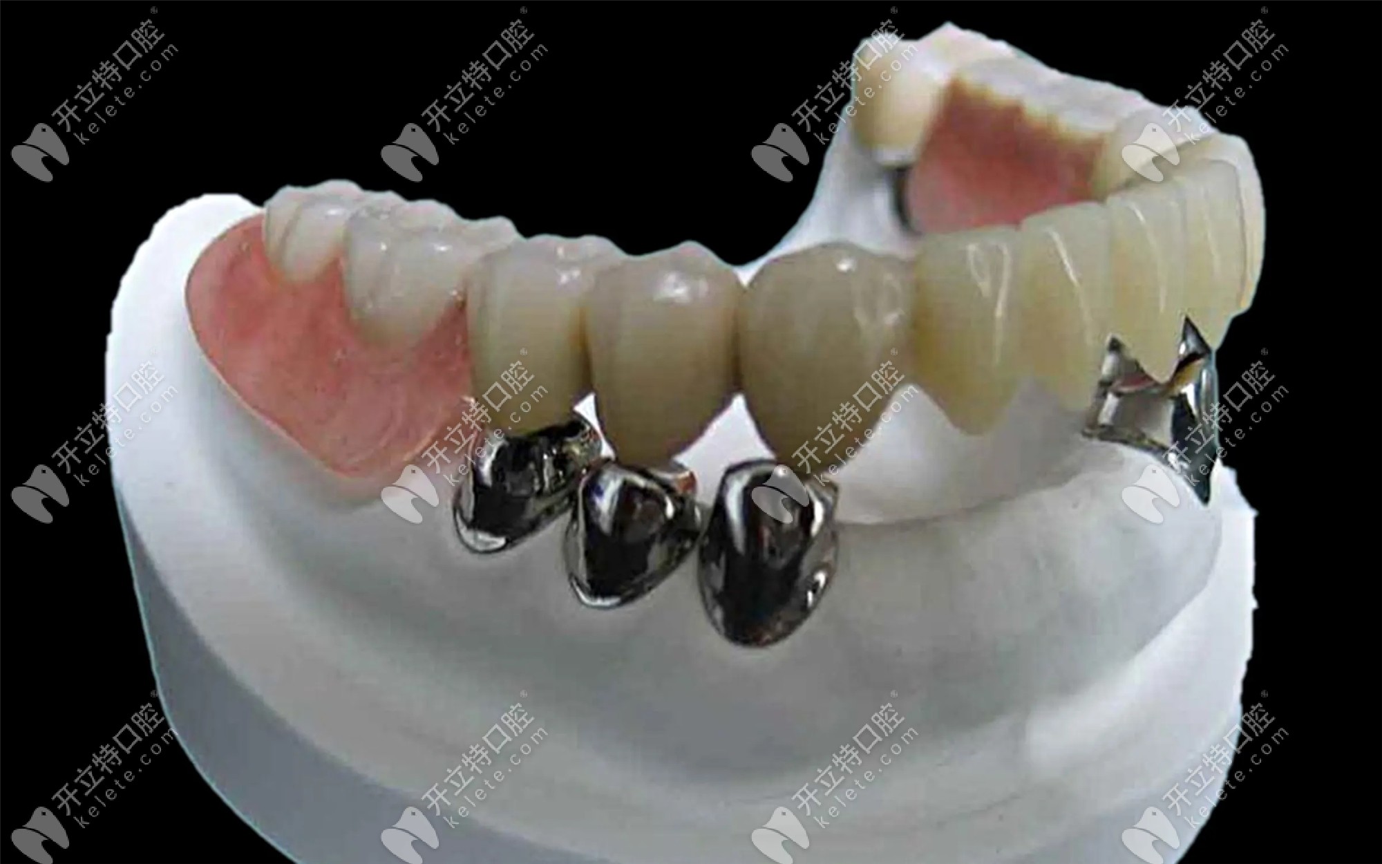 假牙是金属材料