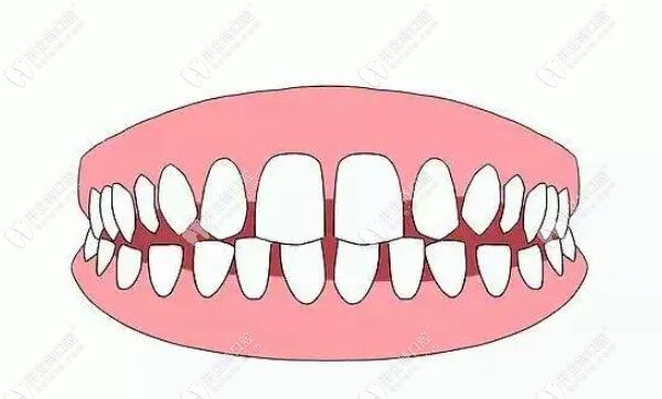 牙齿长得像老鼠牙如何矫正?有人通过戴金属牙套来矫正