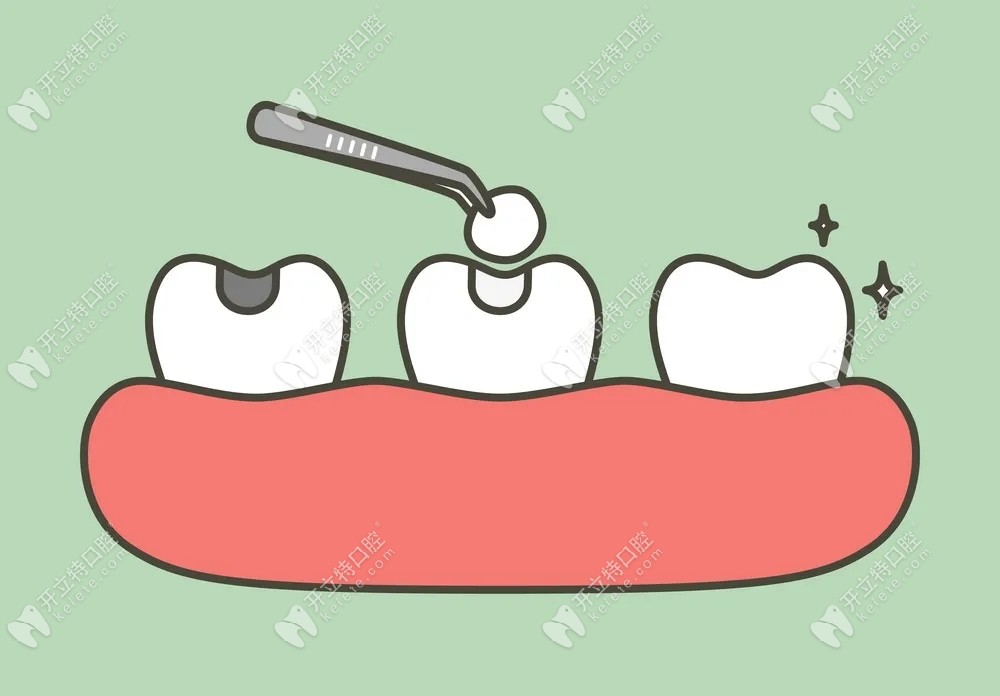 第二次补牙直接补还是把垫底的去掉?二次补牙对牙伤害大吗