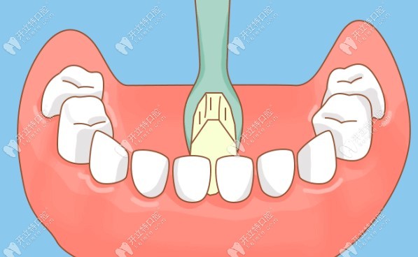 维持种植牙的长期清洁和稳定