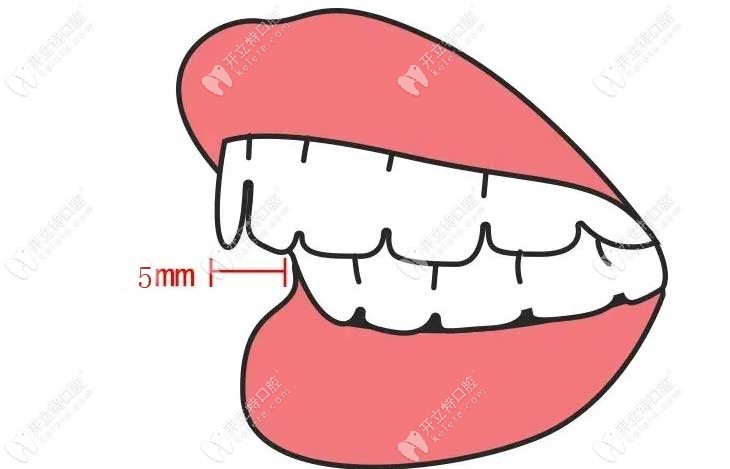 上大门牙外凸5毫米算厉害吗，上牙比下牙突出多少算正常？